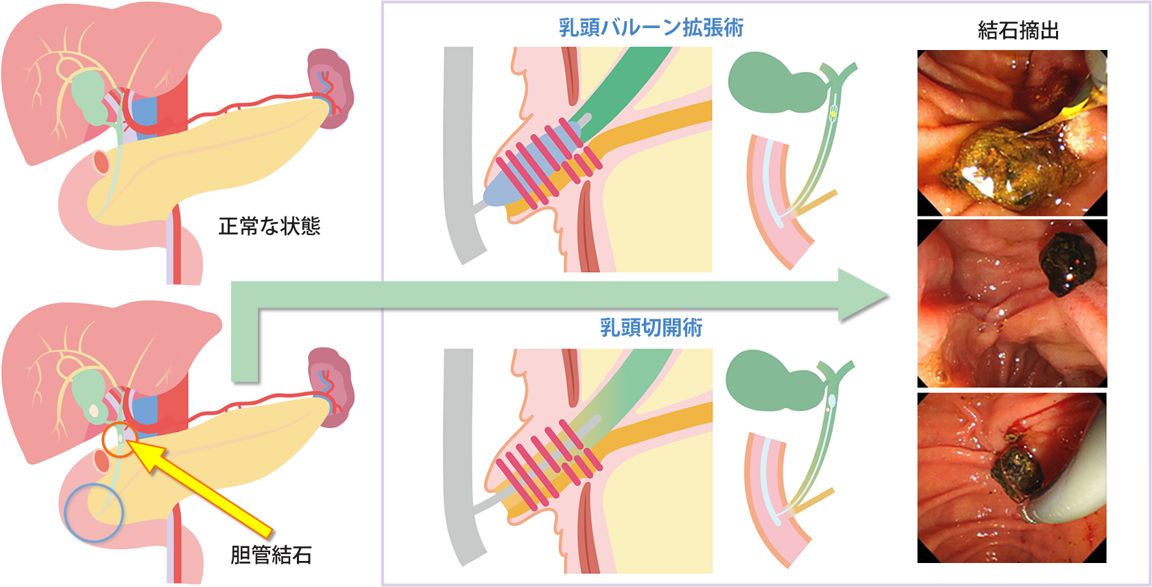 胆管結石治療