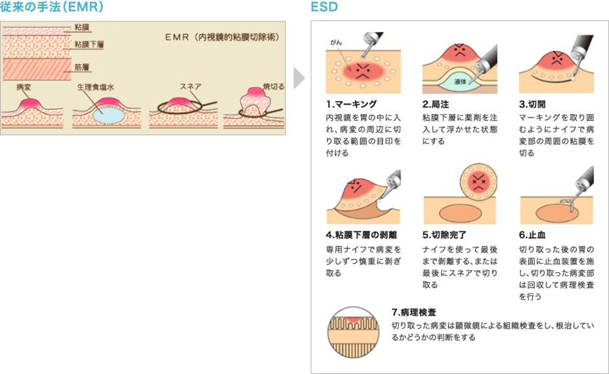 胆ESD（内視鏡的粘膜下層剥離術）