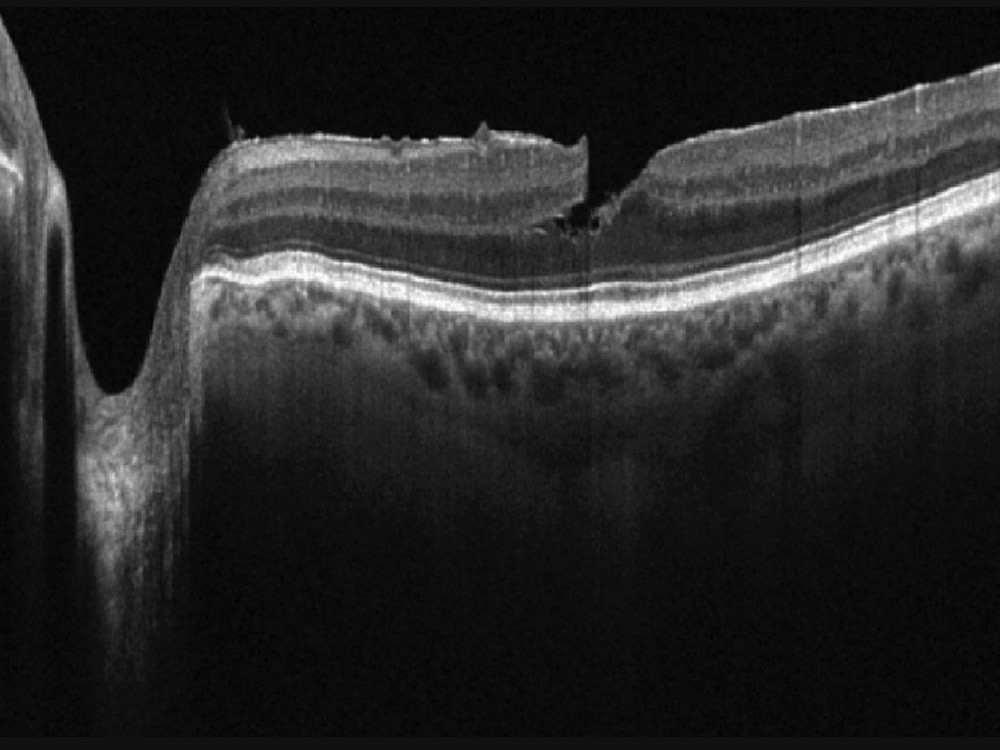 OCT-Cirrus-EDI-DryAMD