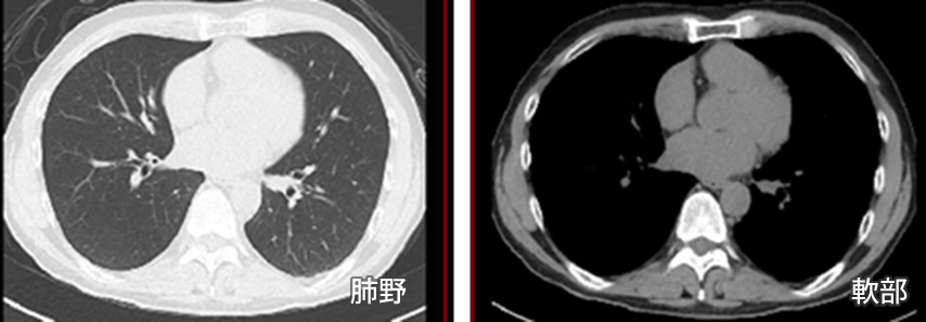 左側は肺野の評価用、右側は軟部組織の評価用